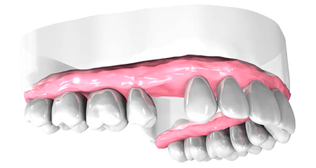 Examen pré-implantaire - Cabinet dentaire Drs Damiani et Richelme - Dentiste Marseille